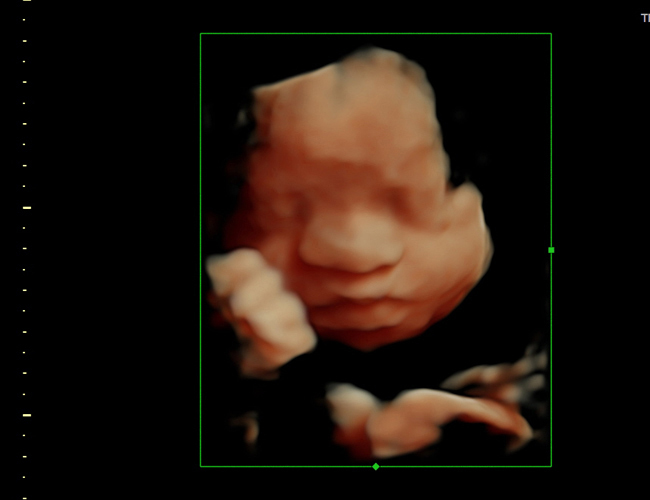 3D ultrasound image at 29 weeks